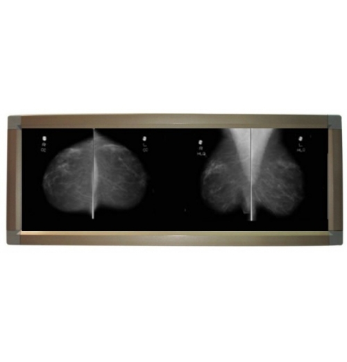 LED Mammography Viewbox