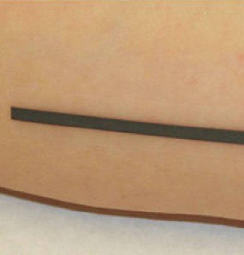 CT Line Reference Point Skin Markers